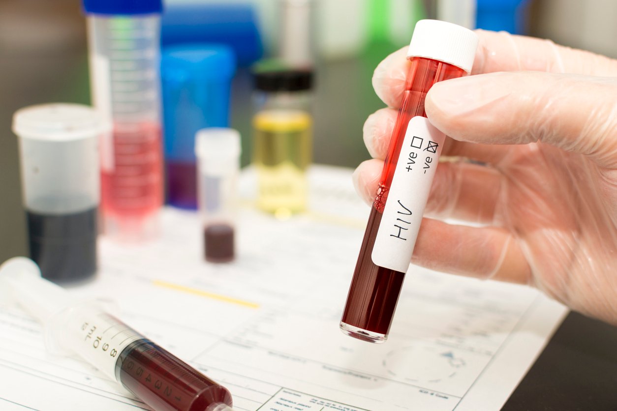 hiv,-il-supporto-dei-medici-di-famiglia-per-scovare-il-sommerso